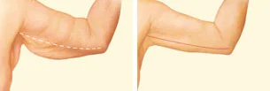 arm-lift-inner-arm-incision.jpg