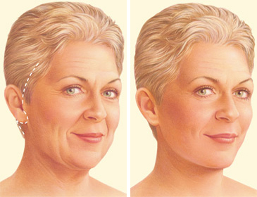 facelift-jonesboro-ar.jpg