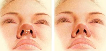 Open rhinoplasty incision across the columella
