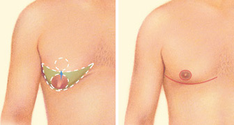 gynecomastia-surgery-jonesboro-ar.jpg
