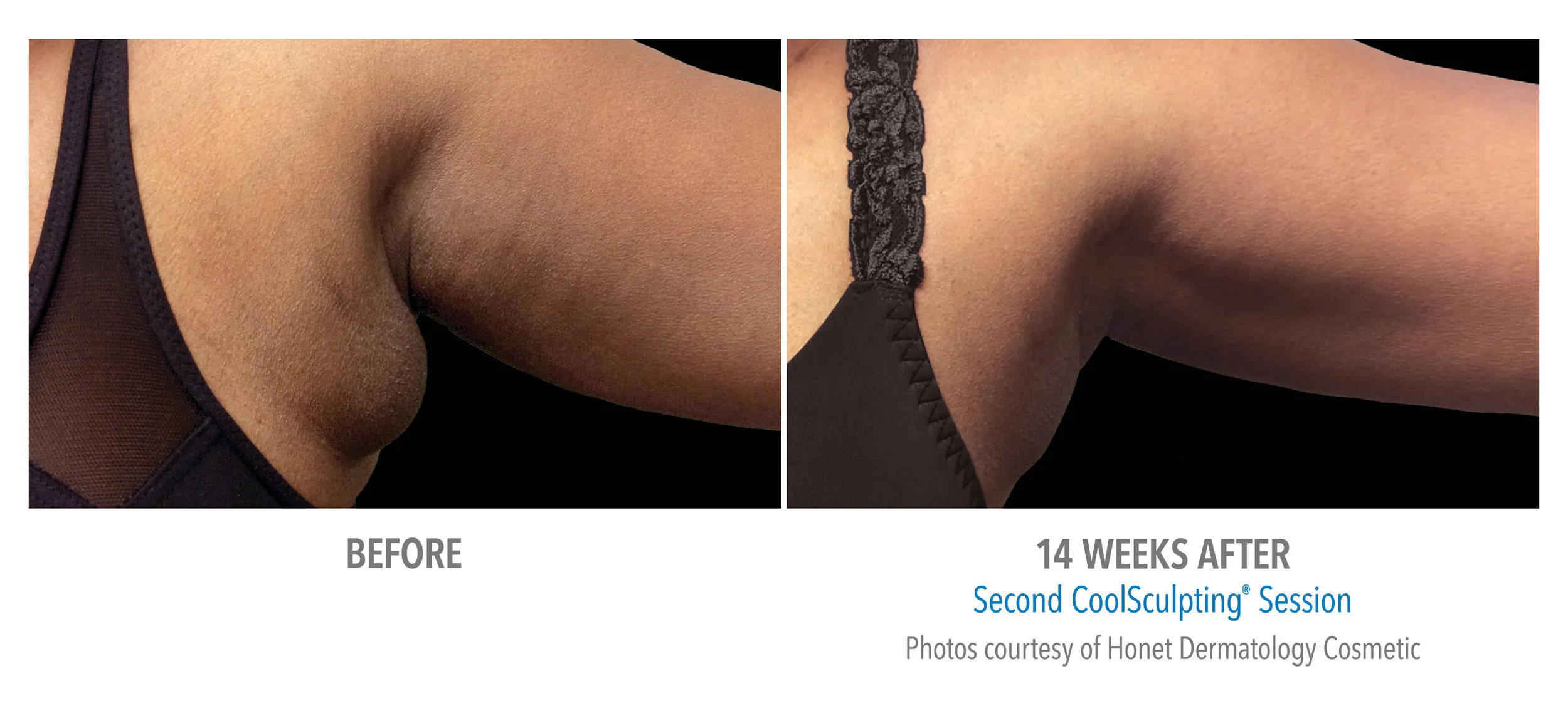 coolsculpting-event-jonesboro-ar.jpg