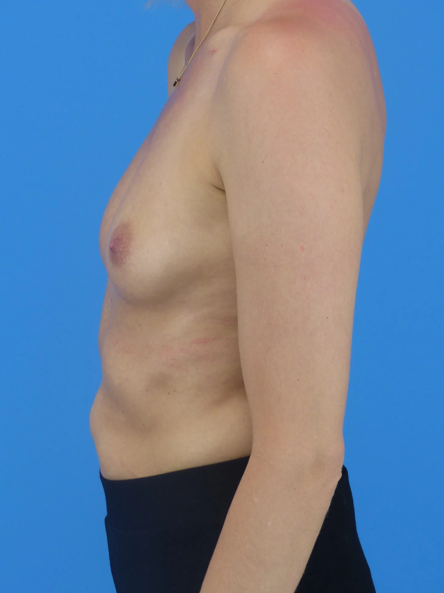 Breast Augmentation (Before)