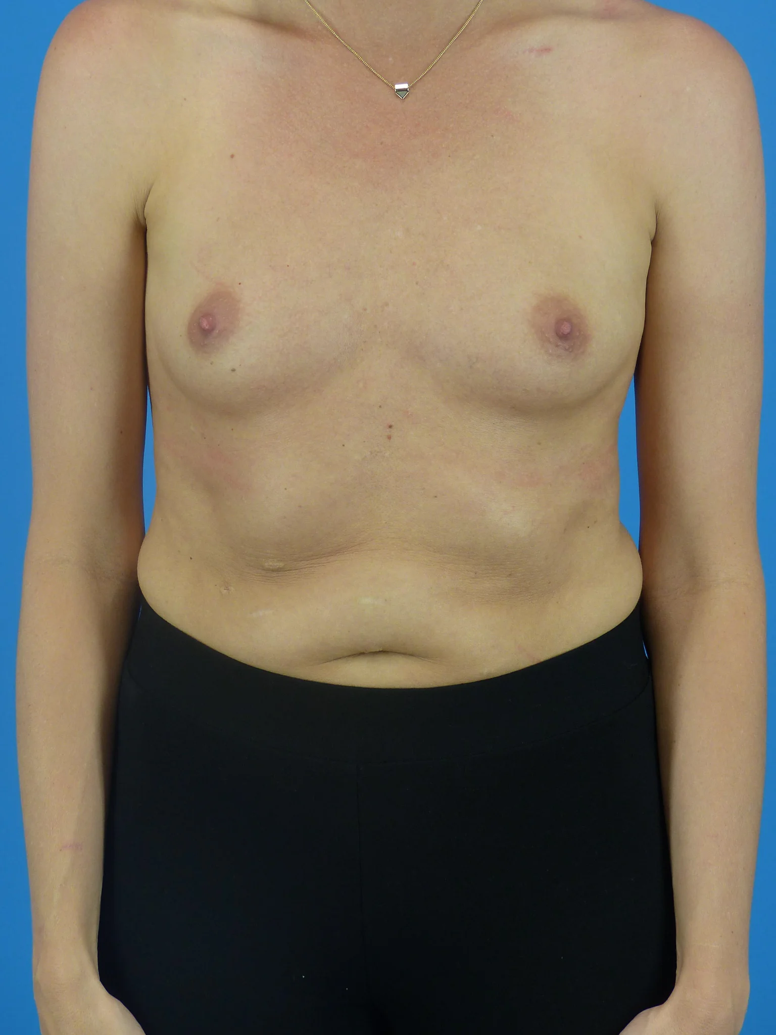 Breast Augmentation (Before)