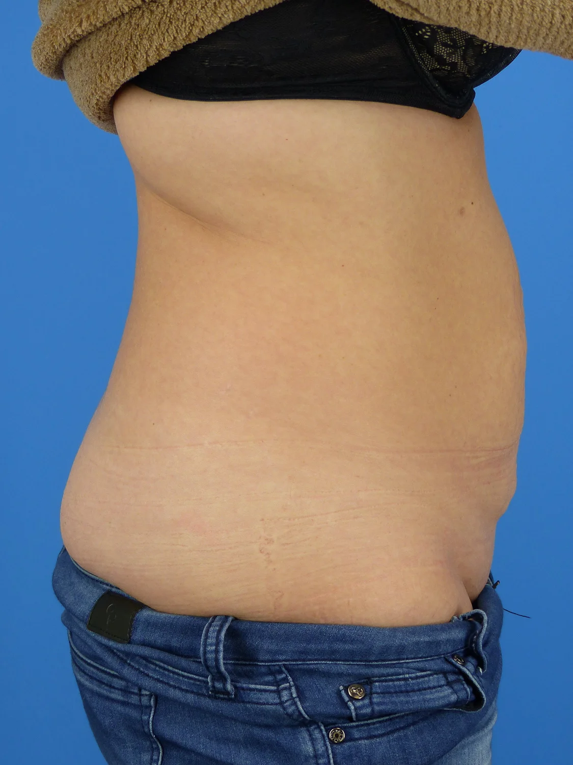 Abdominoplasty (Tummy Tuck) (Before)