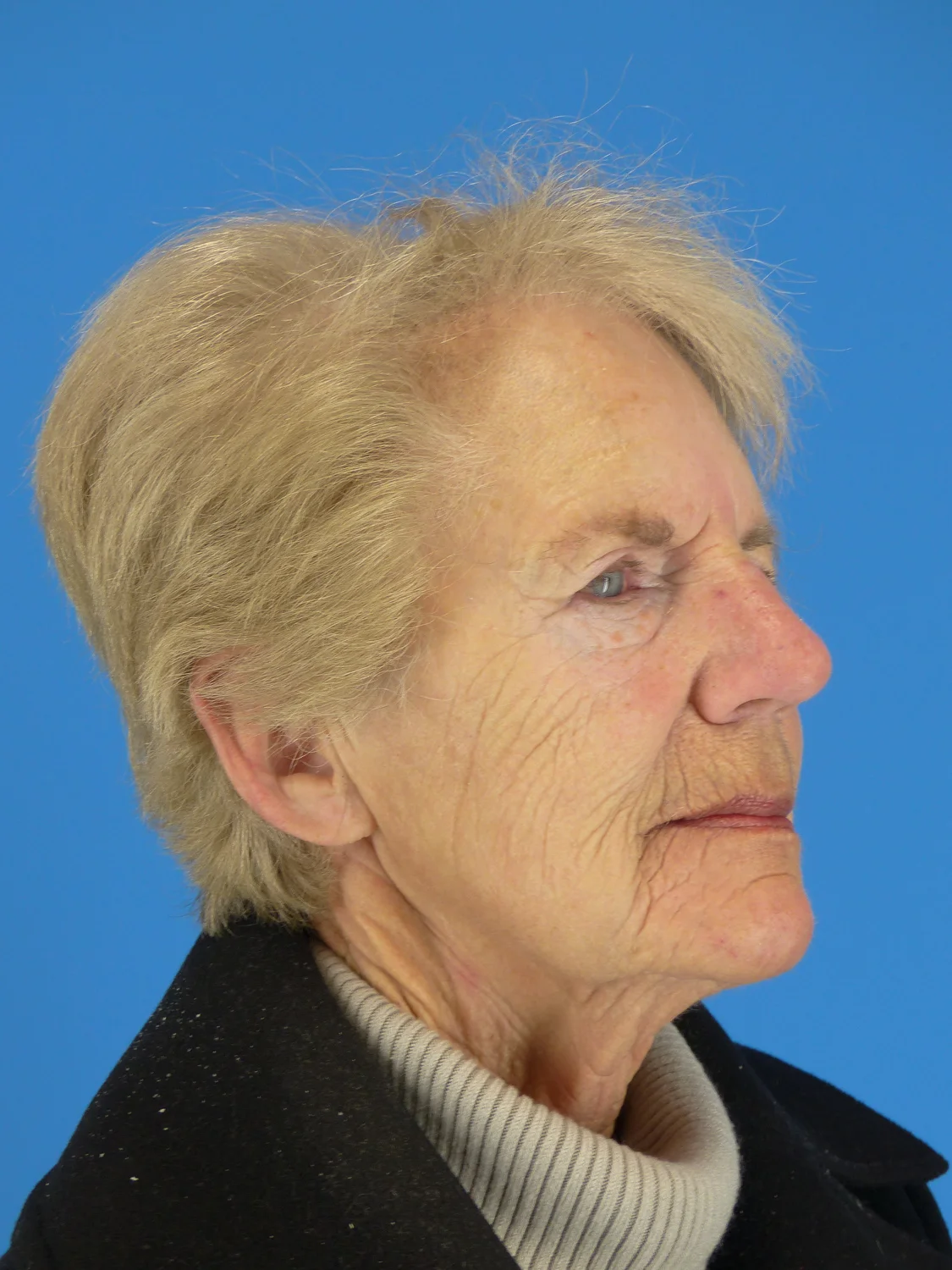 Eyelid Surgery + Brow Lift (Before)