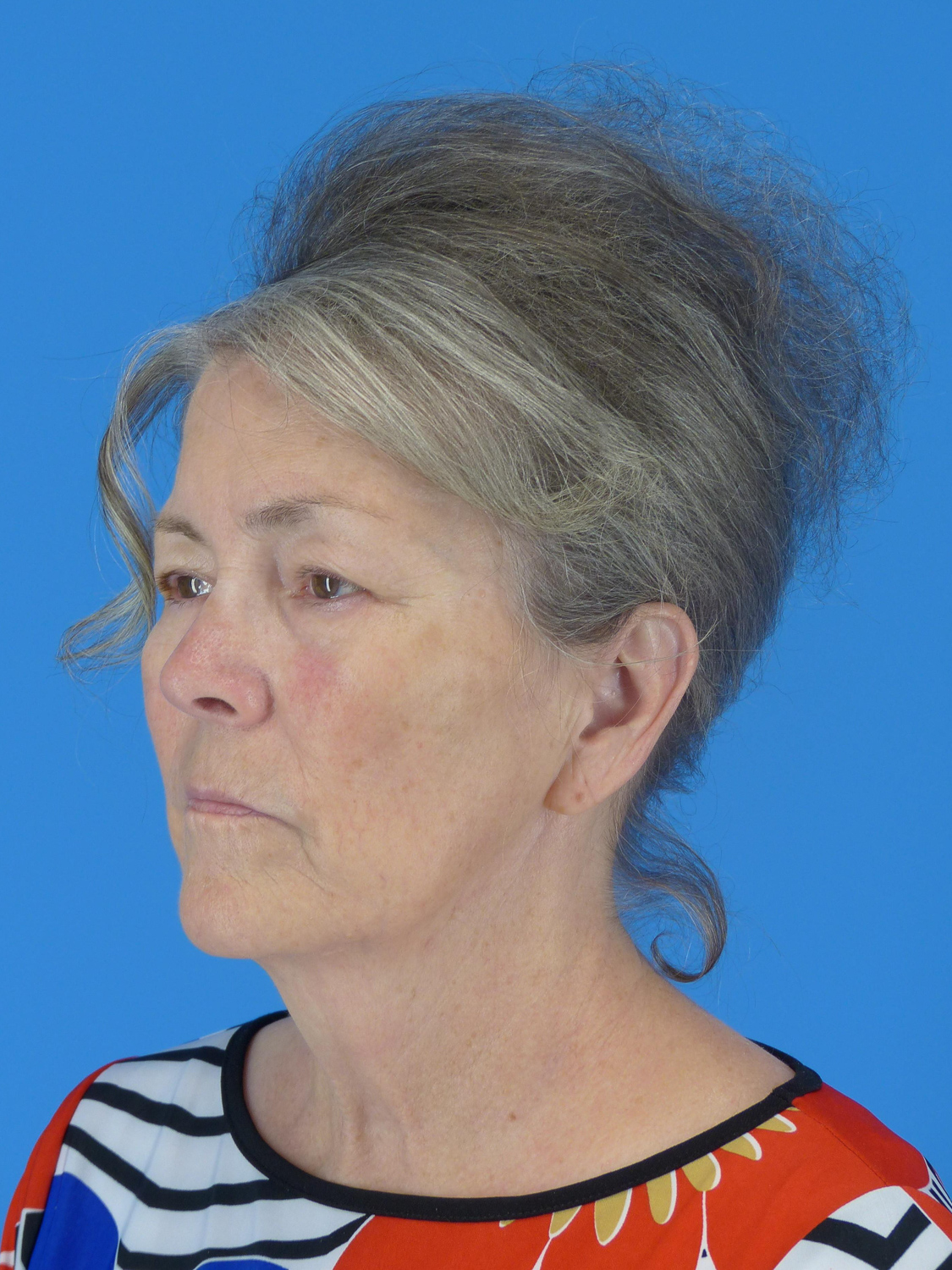 Upper Eyelid Surgery (Before)