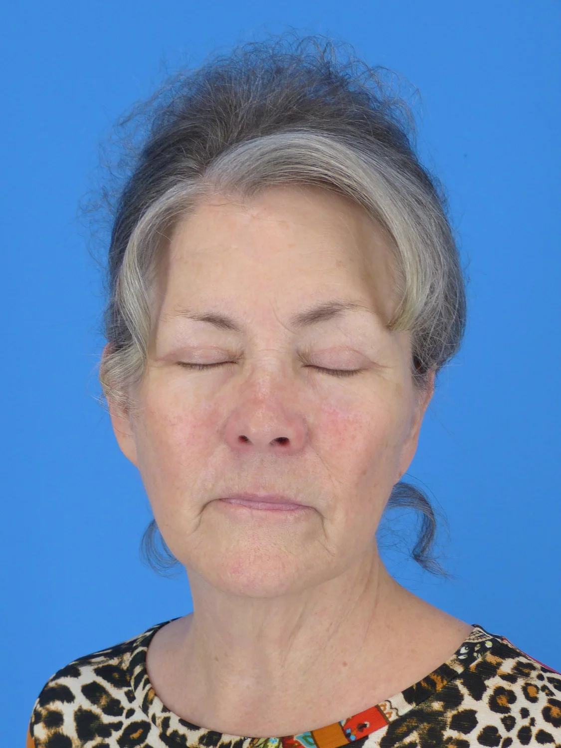 Upper Eyelid Surgery (After)