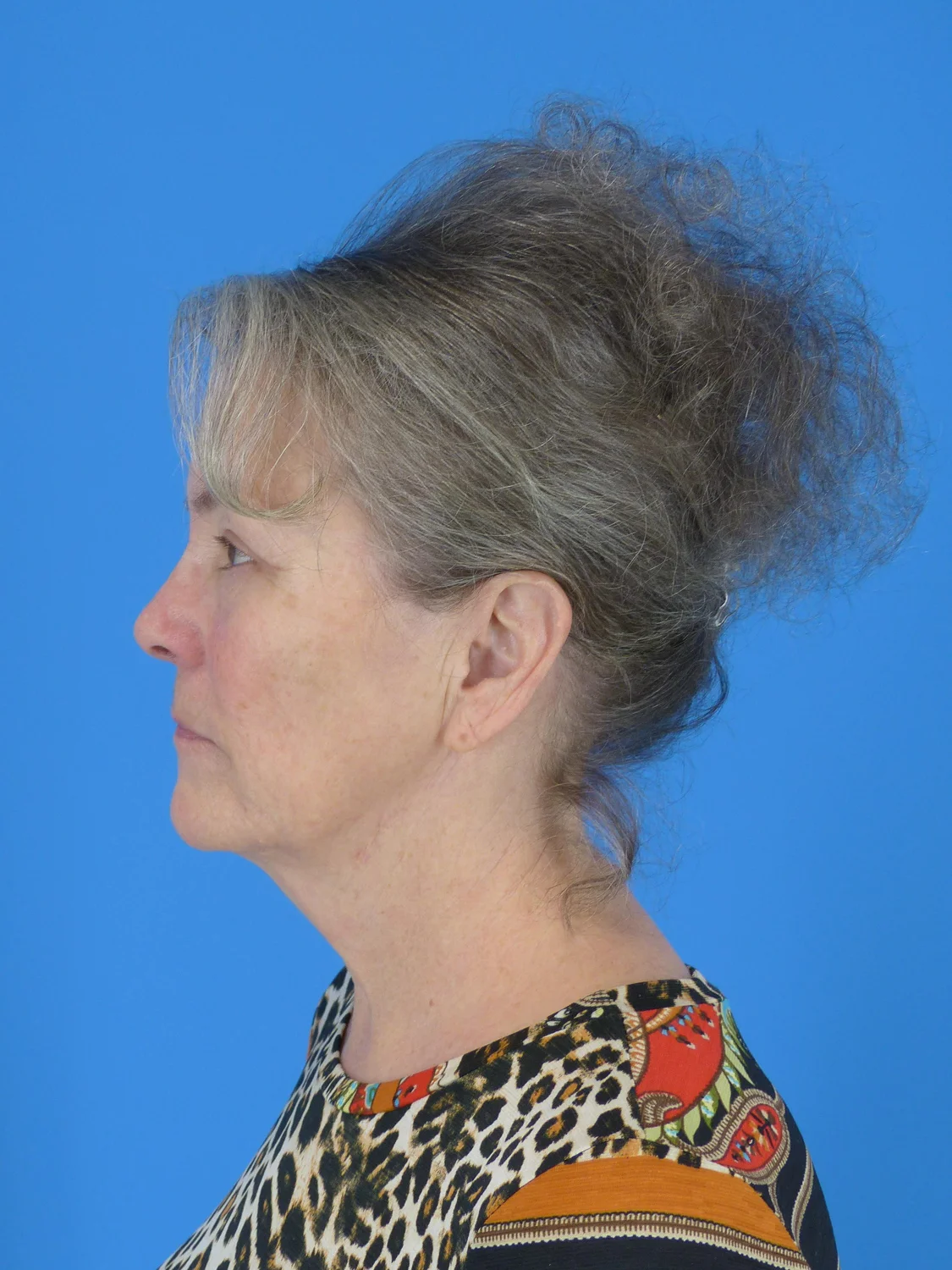 Upper Eyelid Surgery (After)