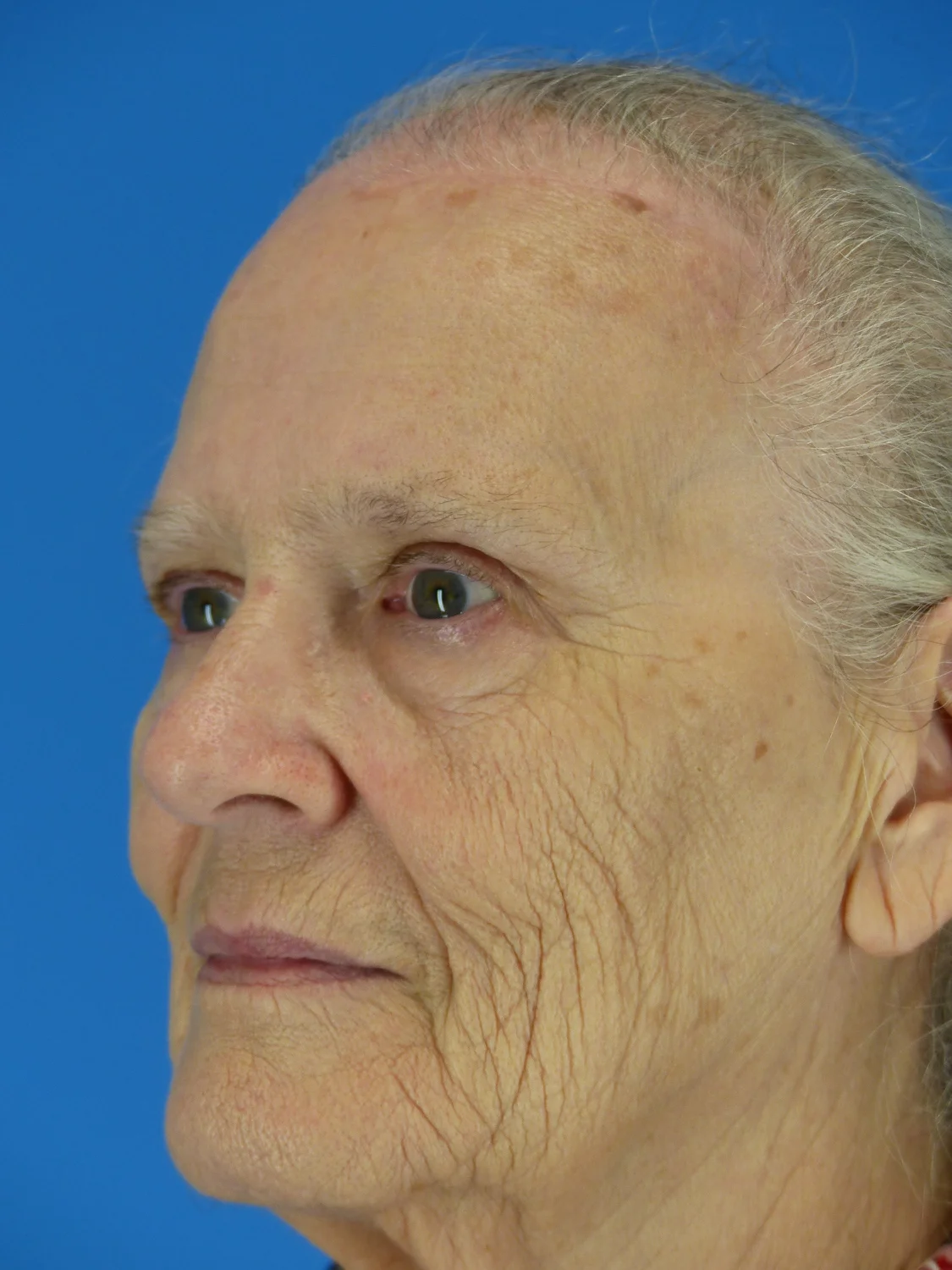 Eyelid Surgery + Brow Lift (After)