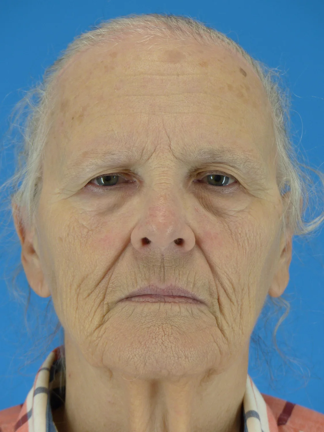 Eyelid Surgery + Brow Lift (Before)
