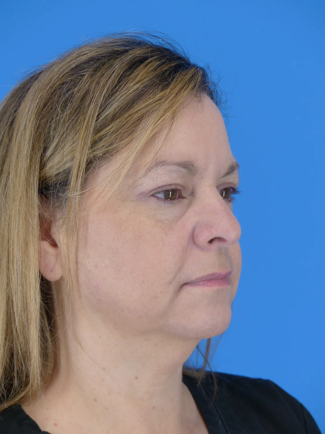 Upper Eyelid Surgery (After)
