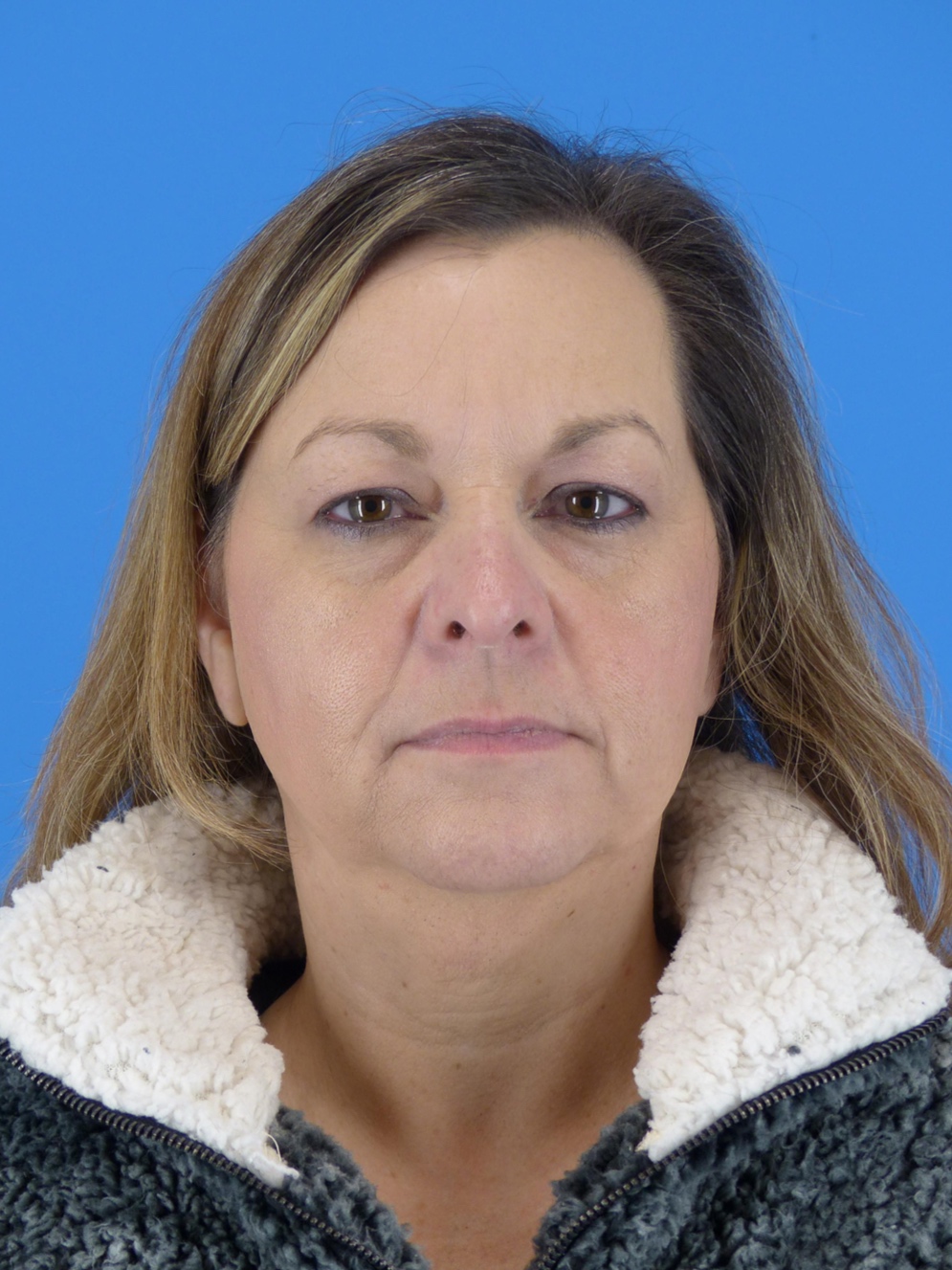 Upper Eyelid Surgery (Before)