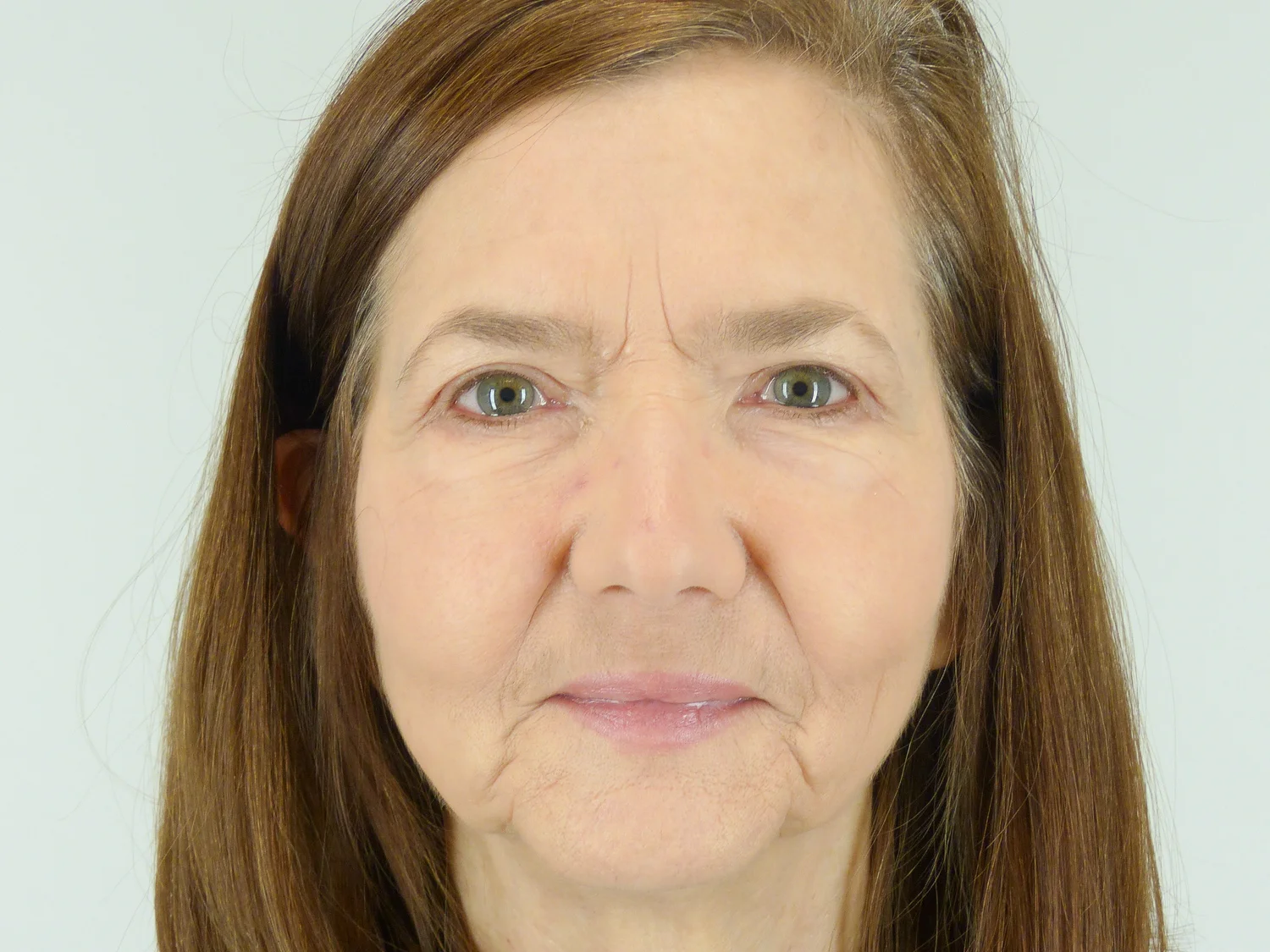 Upper and Lower Blepharoplasty [Eyelid Surgery] (After)