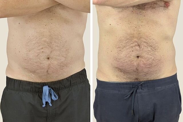 &ldquo;Dad bod&quot; be gone! @CoolSculpting targets stubborn fat in both men and women. If you can squeeze it, we can freeze it! 
Schedule your *free* #CoolSculpting consultation with Dr. Majewski today to see if CoolSculpting is right for you. #fat