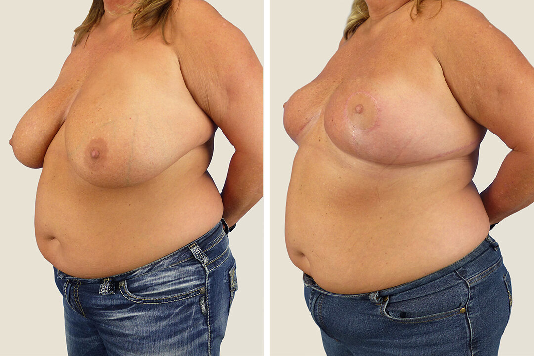 Breast Reduction - Plastic Surgery - Jonesboro, AR — Majewski Plastic Surgery Breast Reduction - Plastic Surgery - Jonesboro, AR — Majewski Plastic Surgery