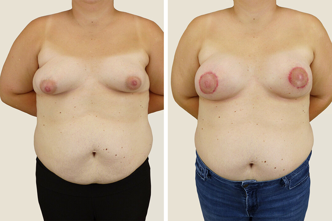 Breast Lift Plastic Surgery - Jonesboro, AR — Majewski Plastic
