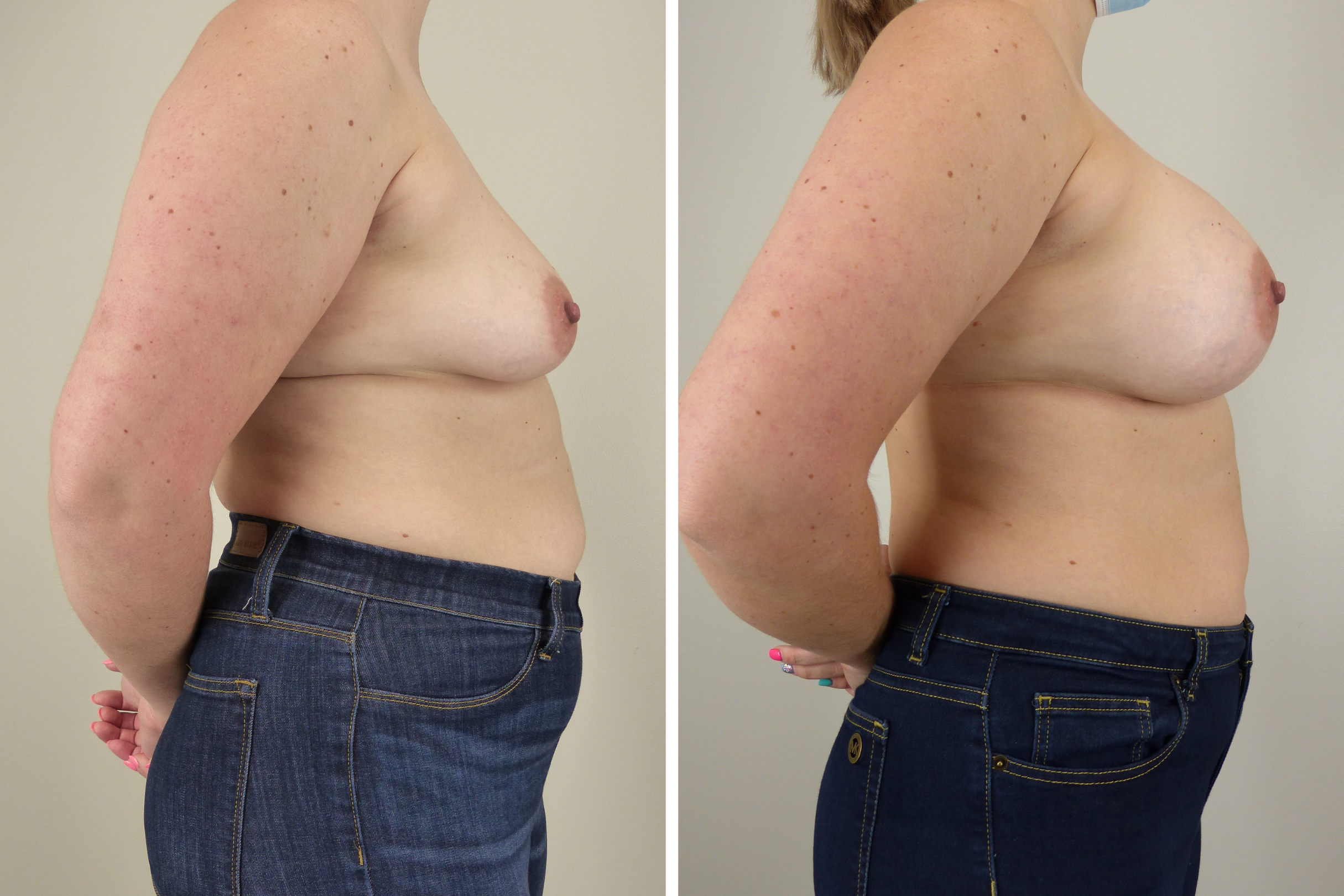 Breast Augmentation - Plastic Surgery - Jonesboro, AR — Majewski Plastic  Surgery, image size:2430x1620