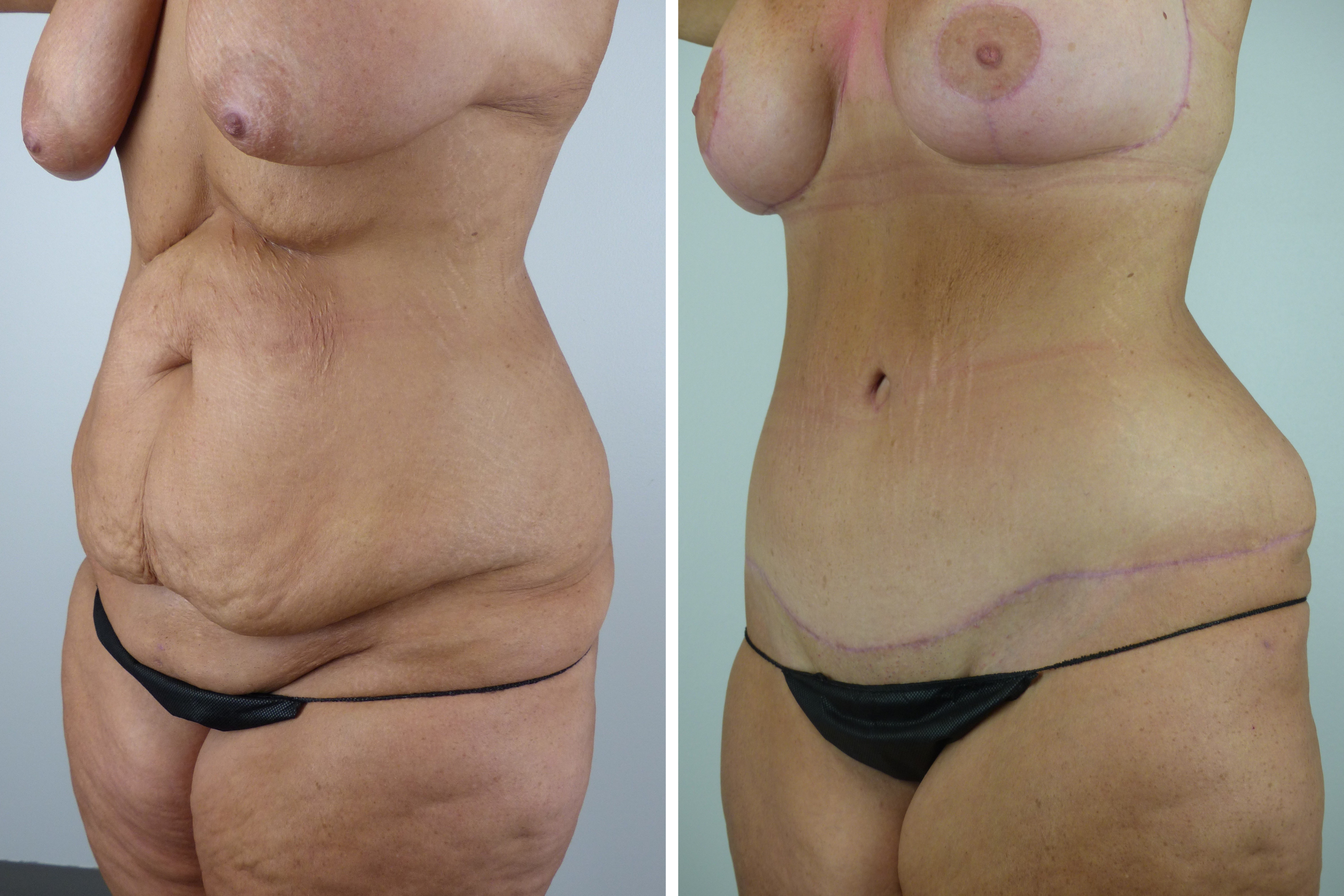 Mommy Makeover Results by Dr. W. Tomasz Majewski