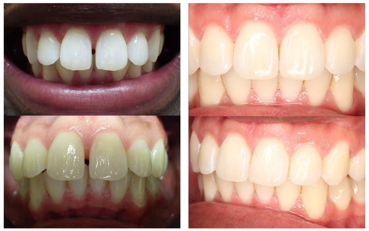 before-after-emsumb.jpg