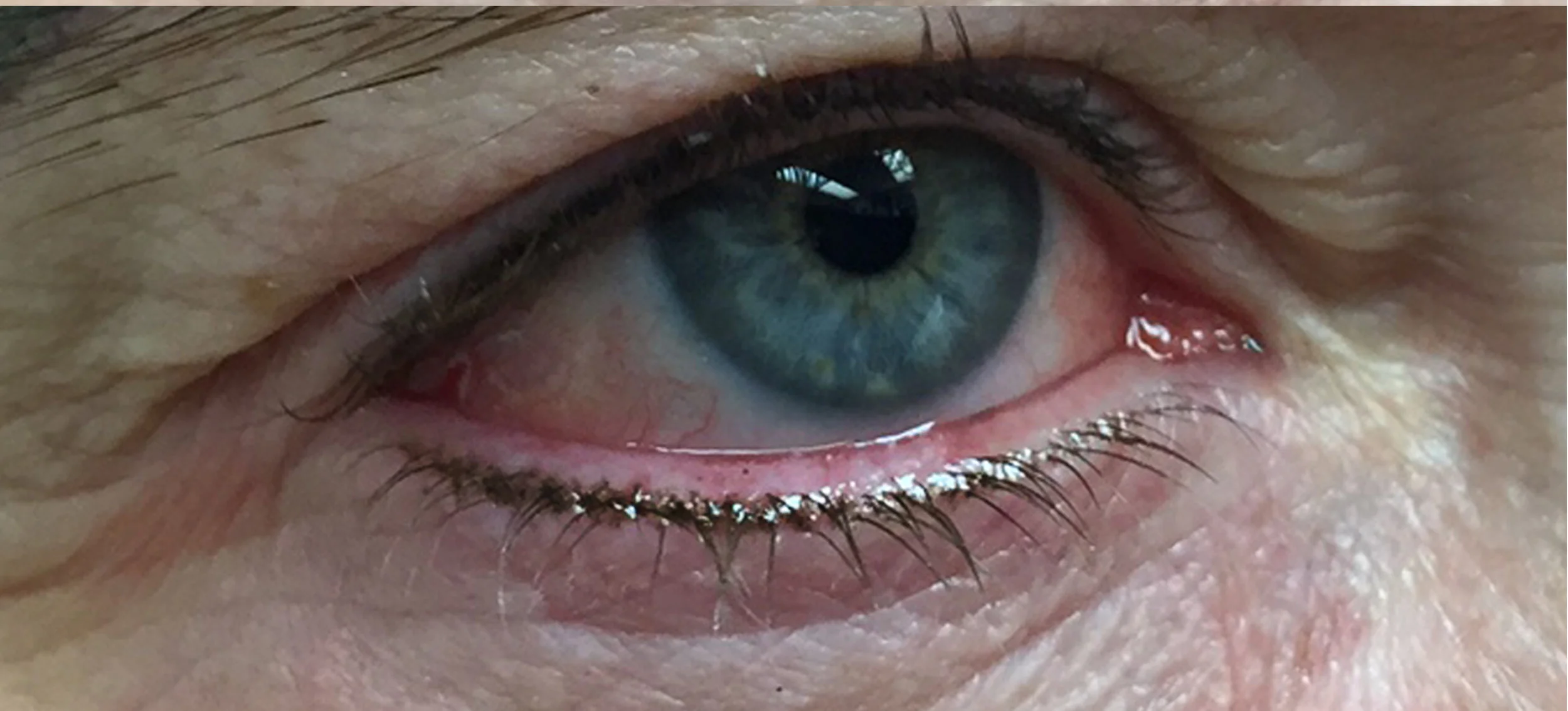 Lash Enhancement
