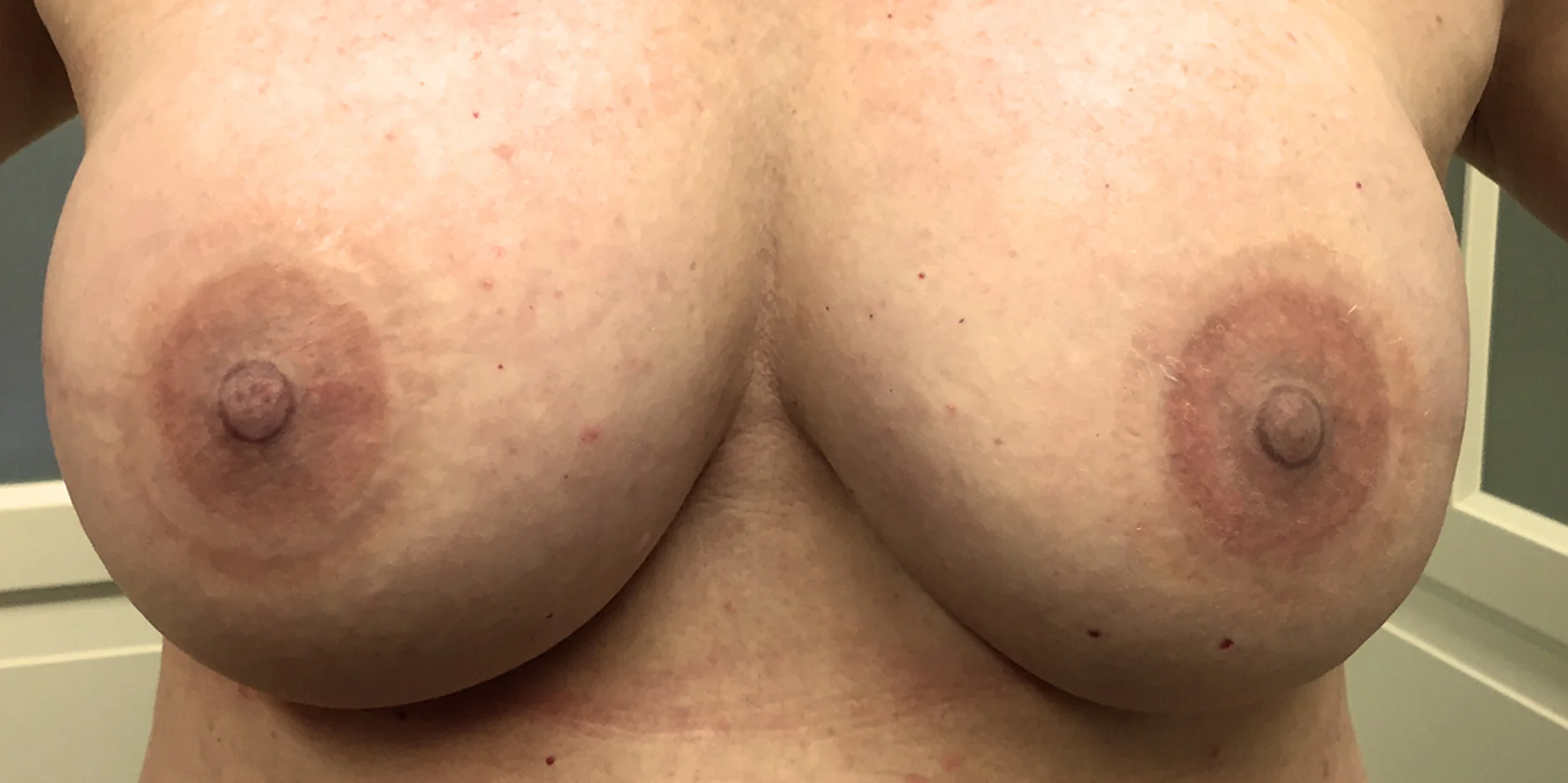 Corrective Areola