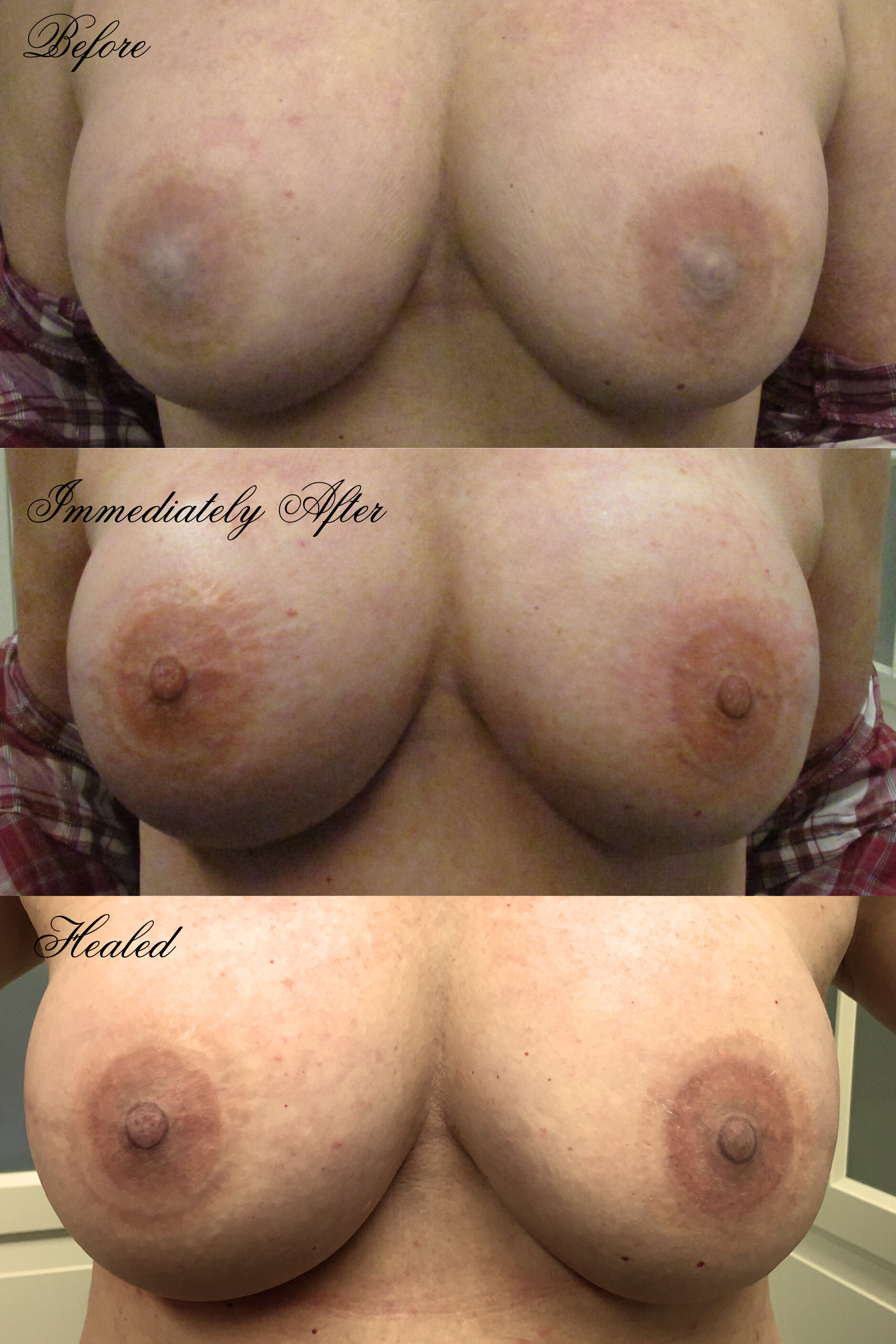 Liz Cook Tattoo Permanent Makeup Areola Corrective Before After Healed.jpg