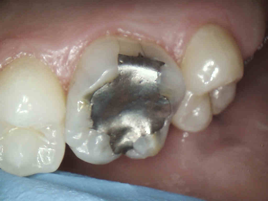Intra-oral upper right molar (#3) with multiple fractures along the filling.