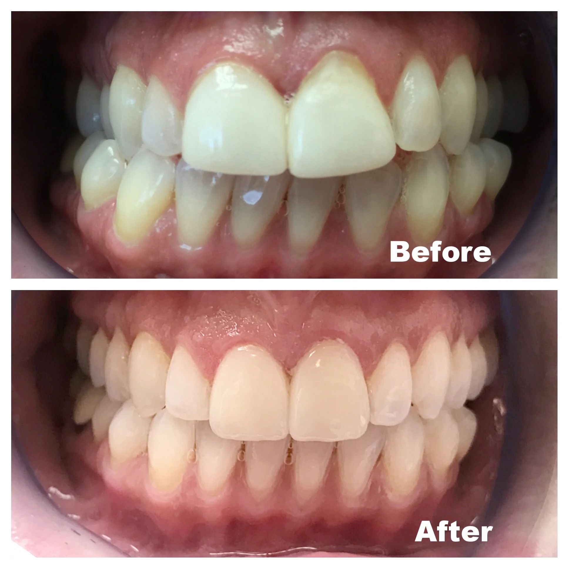 Clear Aligner Therapy and Veneers