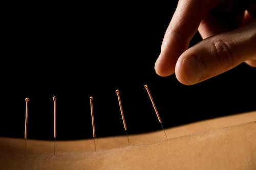 Acupuncture WEB.jpeg