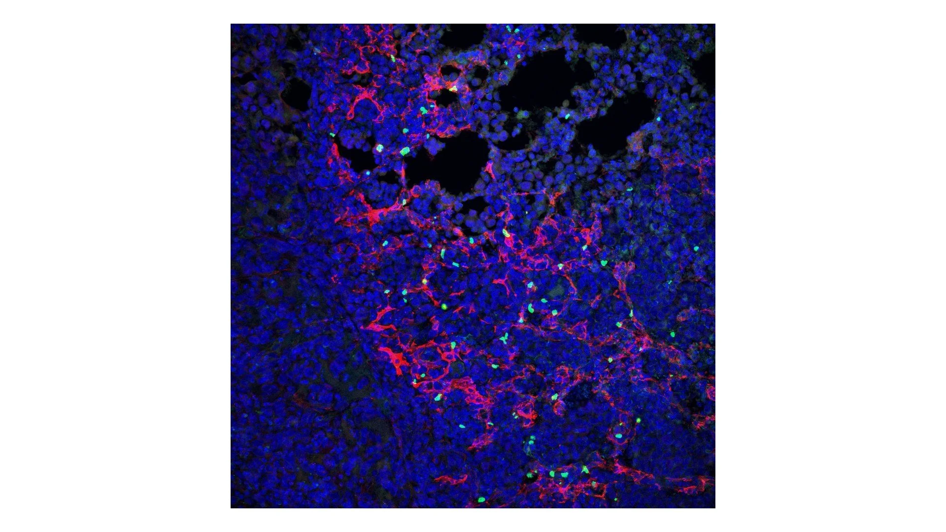 TREGS AND imCAFS IN LUNG TUMORS