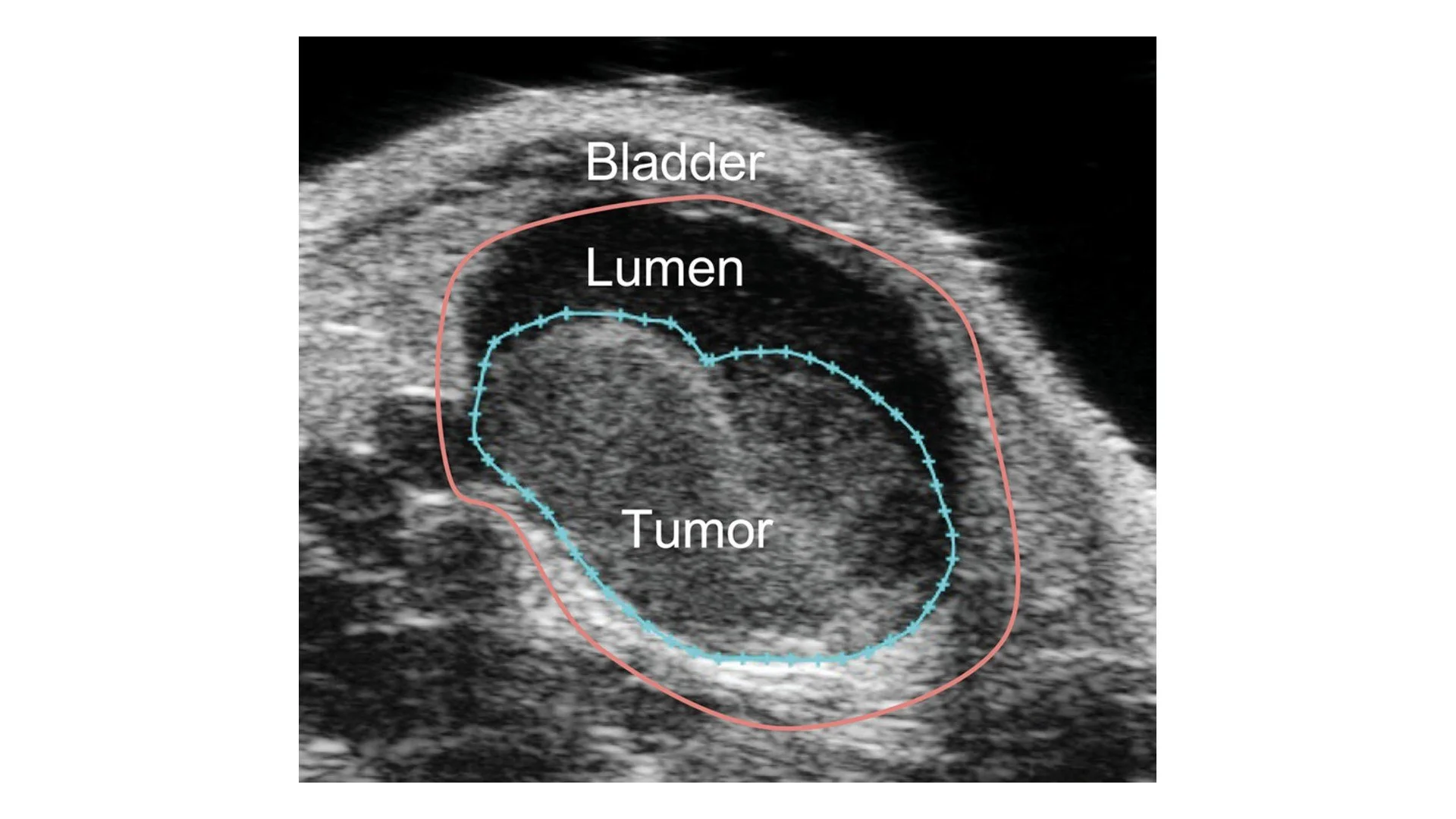 IMAGING BLADDER TUMORS