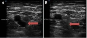 Figure 2. Normal Compressibility of the Popliteal Vein as Assessed by Ultrasound. The image on the left (A) shows the proximal portion of the left femoral artery (superior) and vein (inferior, red arrow), and the image on the right (B) shows the same femoral artery and vein under compression. Because of the relatively low intraluminal pressure in the vein, it is compressible and occluded and therefore disappears from ultrasound. If the vein was found not to be compressible, it would be suggestive of a thrombus within the lumen. When this occurs in the deep veins of an extremity, it is known as a DVT. CVI is not usually caused by DVT.