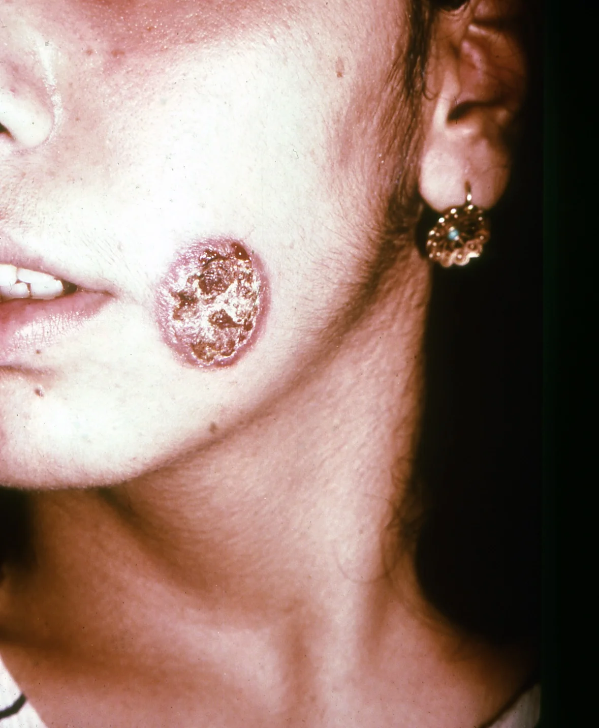 Cutaneous leishmaniasis, old lesion.