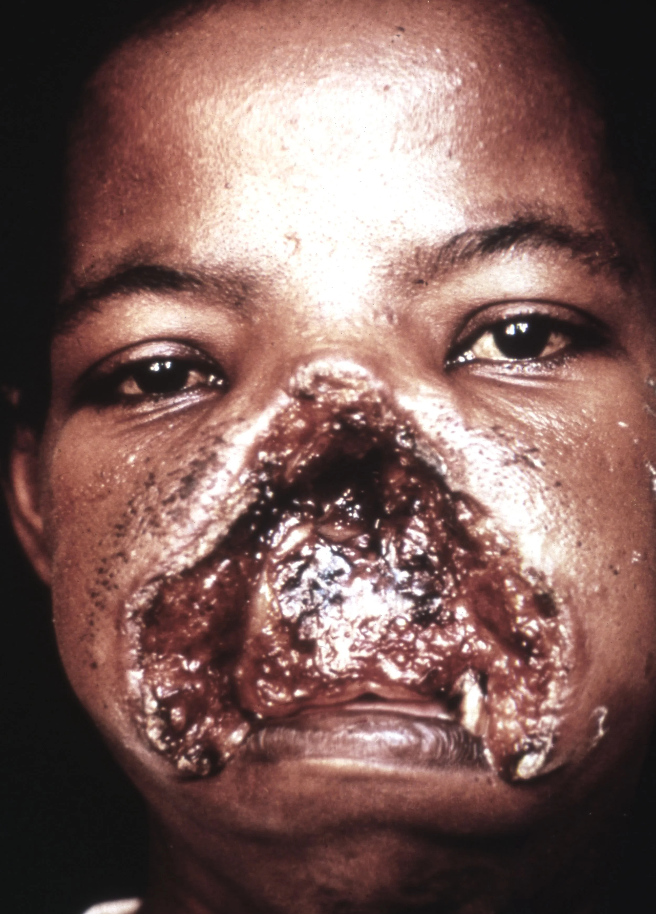 Espundia - severe mucocutaneous leishmaniasis.
