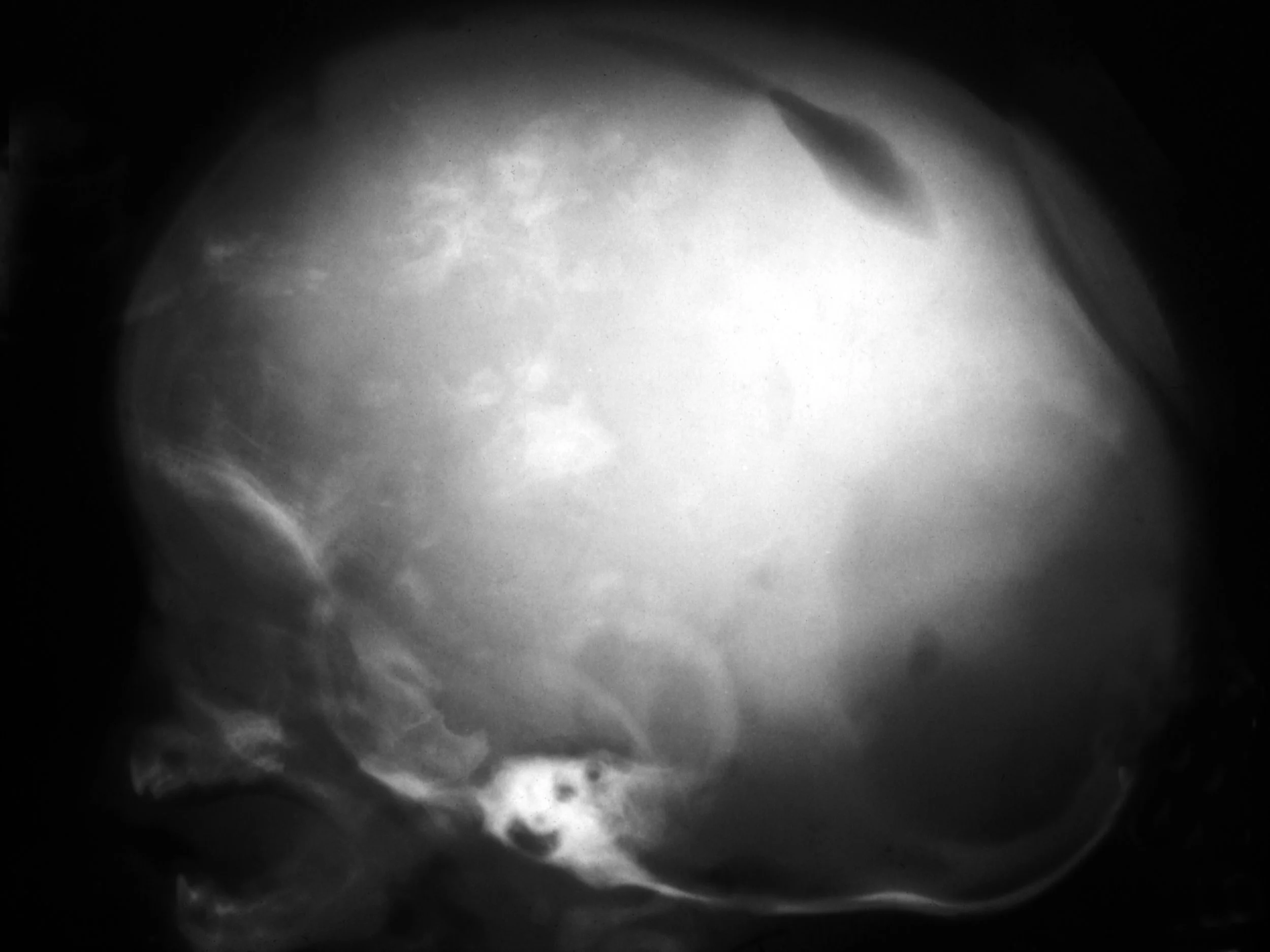Congenital toxoplasmosis - calcified plaques.