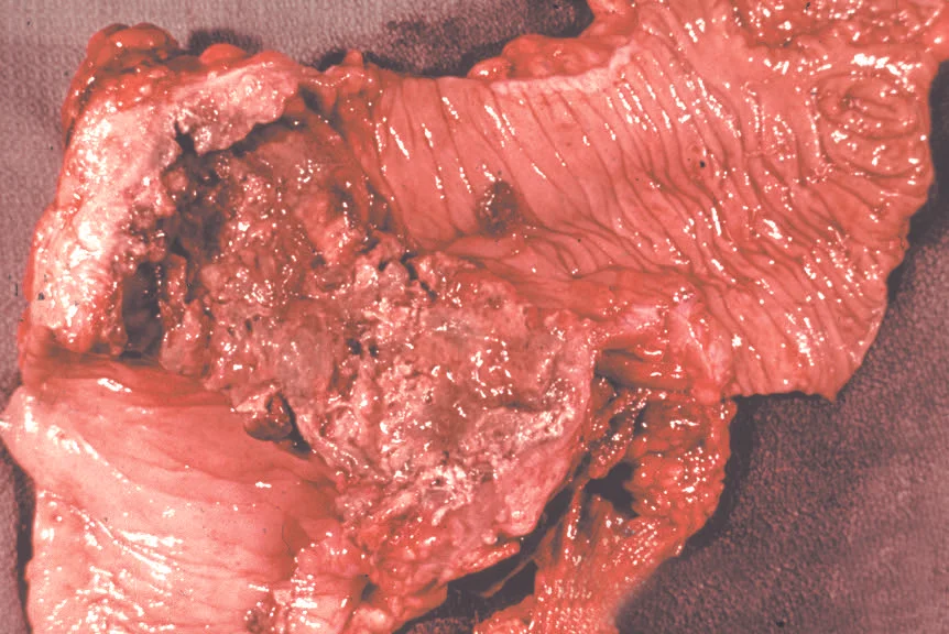 Flask-shaped ulcers due to Entamoeba histolytica . Fatal case.