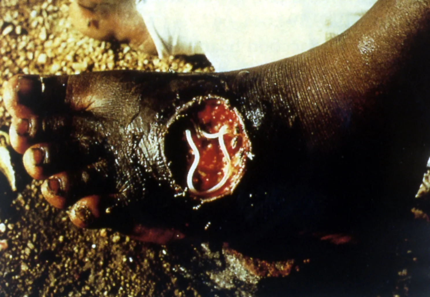 Acute case of Dracunculus medinensis . 