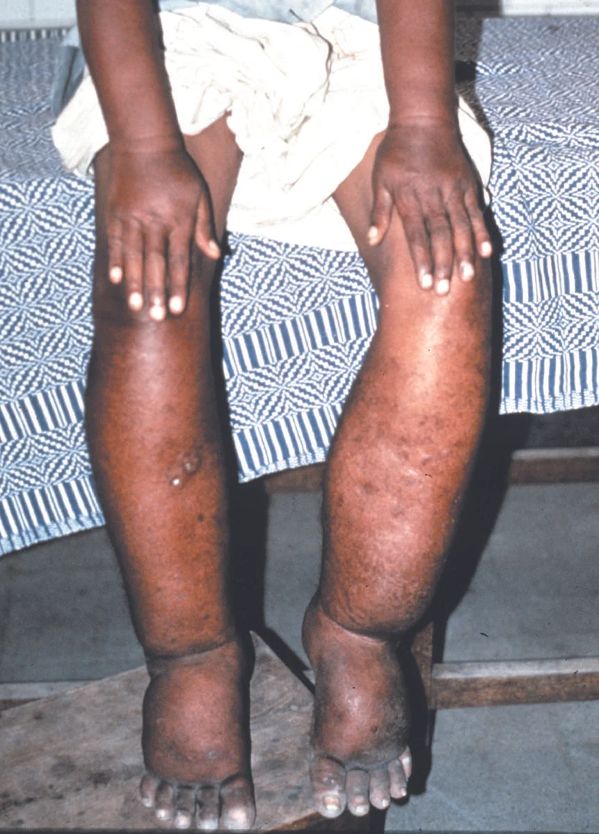Elephantiasis due to infection with Wuchereria bancrofti .