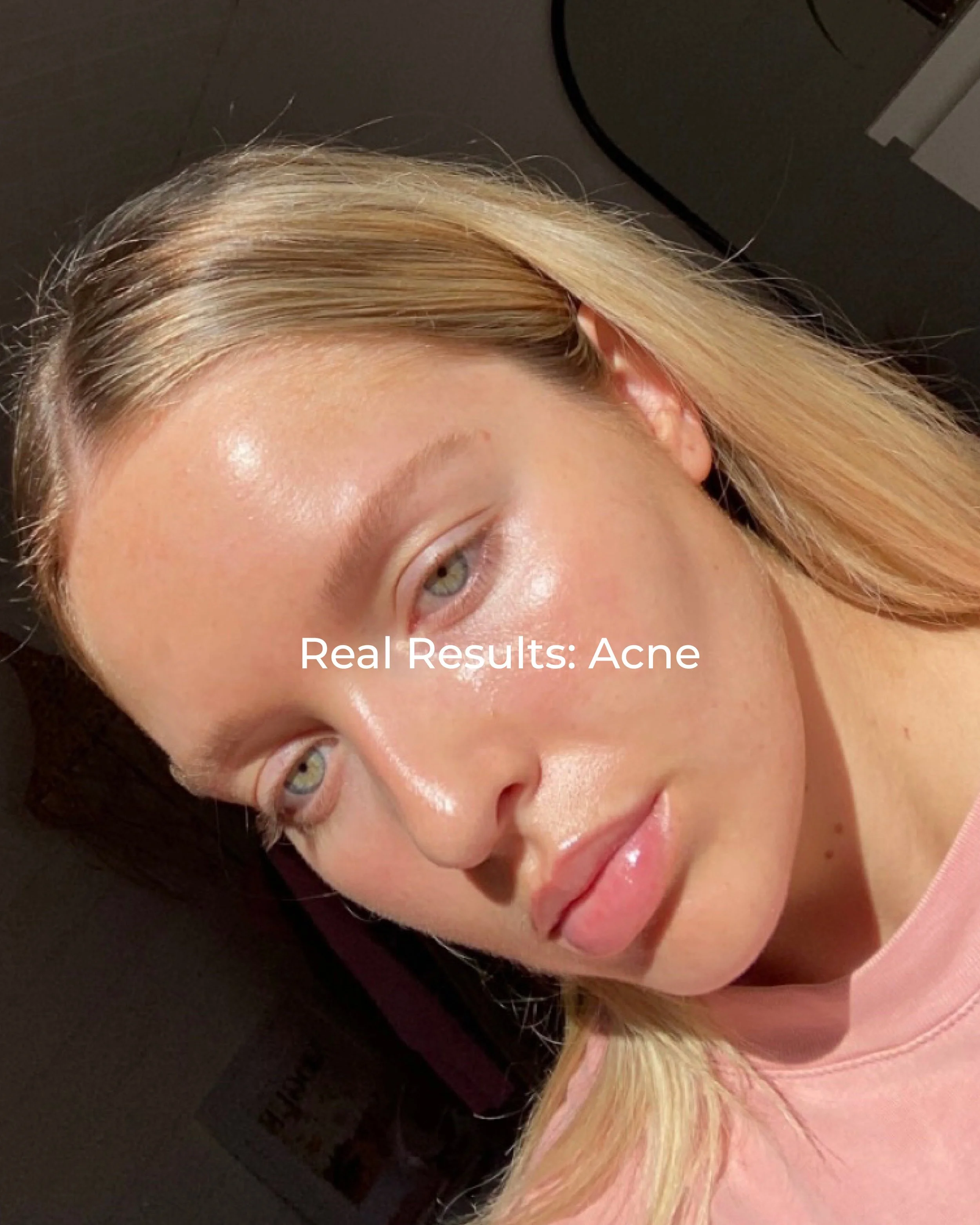 acne real results 1.jpg