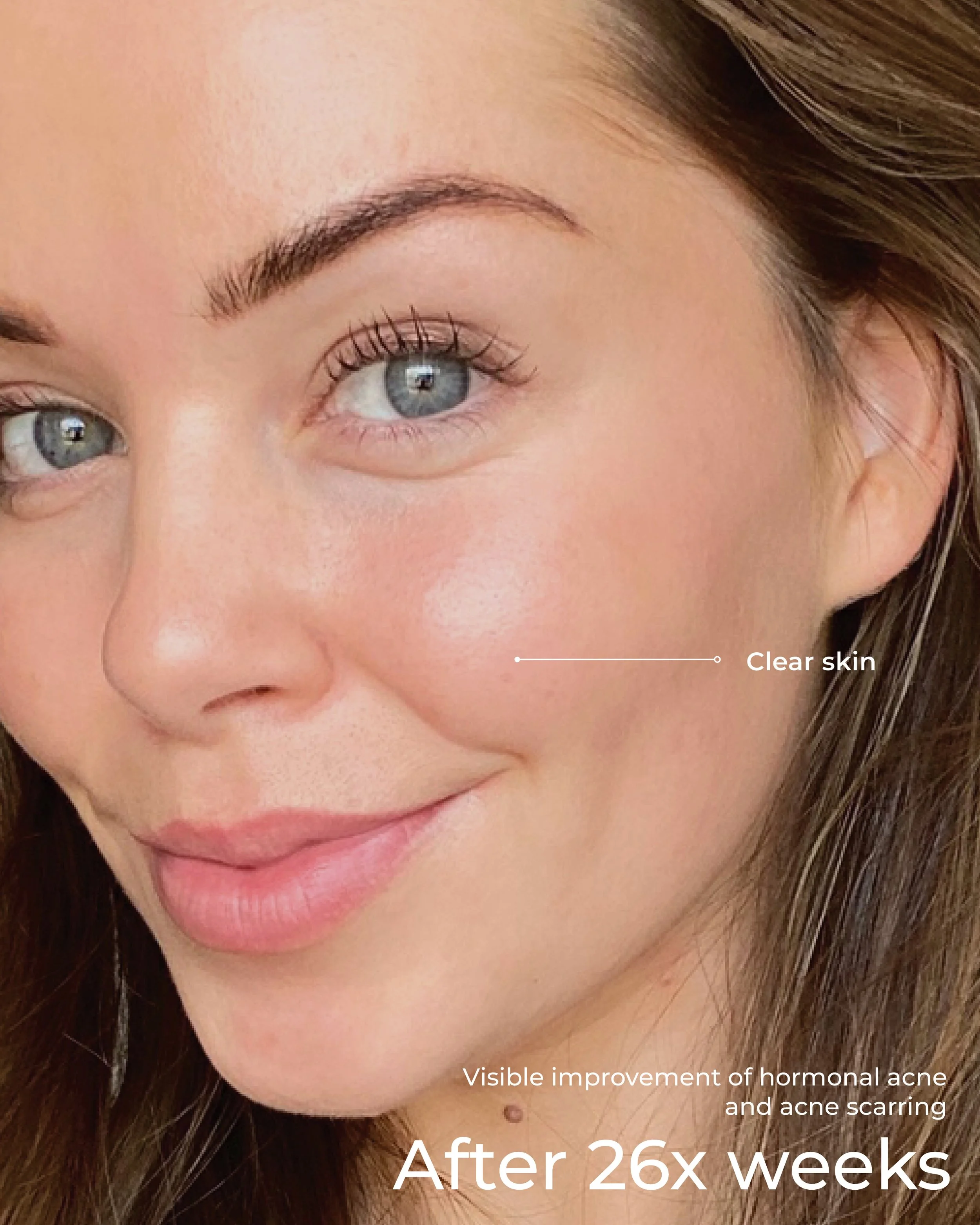 acne real results 5.jpg