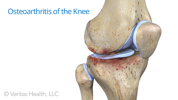 osteoarthritis-knee.png