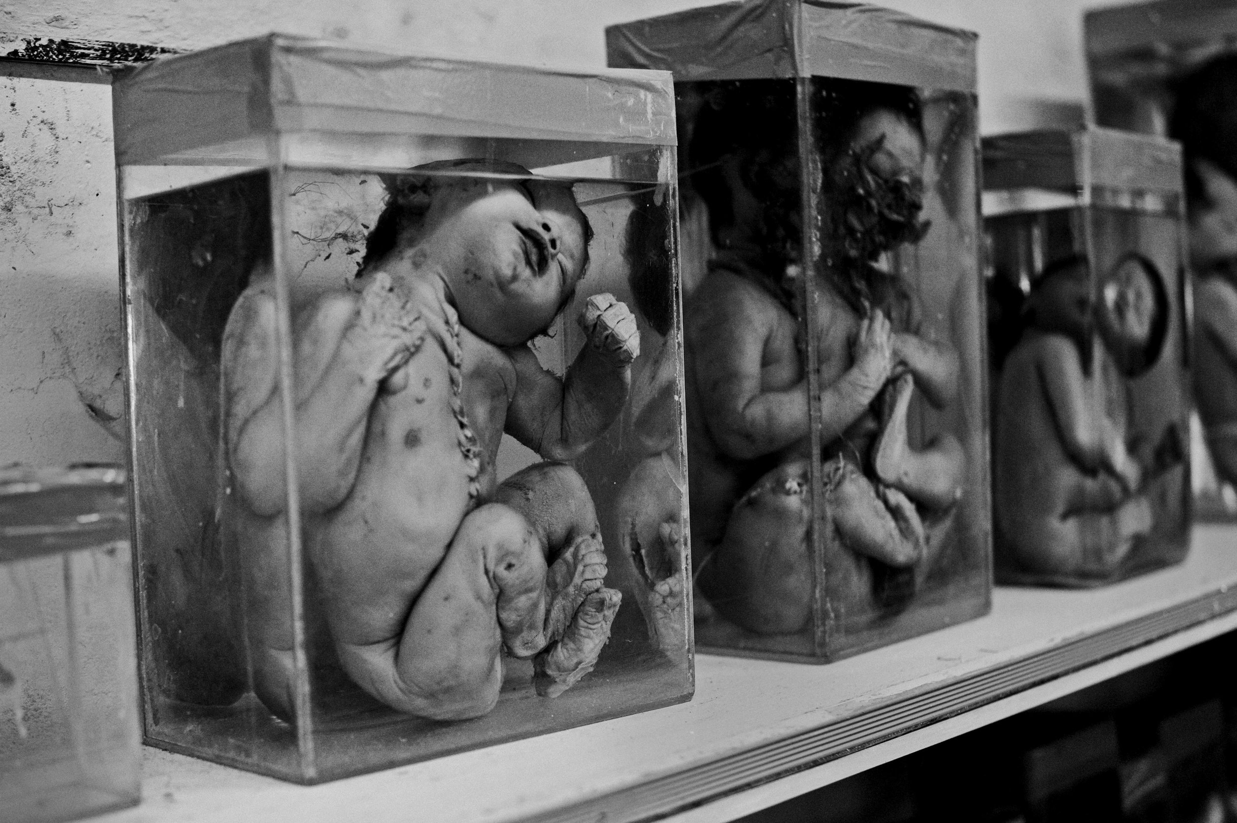  Stillborn fetuses sit on display at a museum commemorating the Union Carbide disaster. 