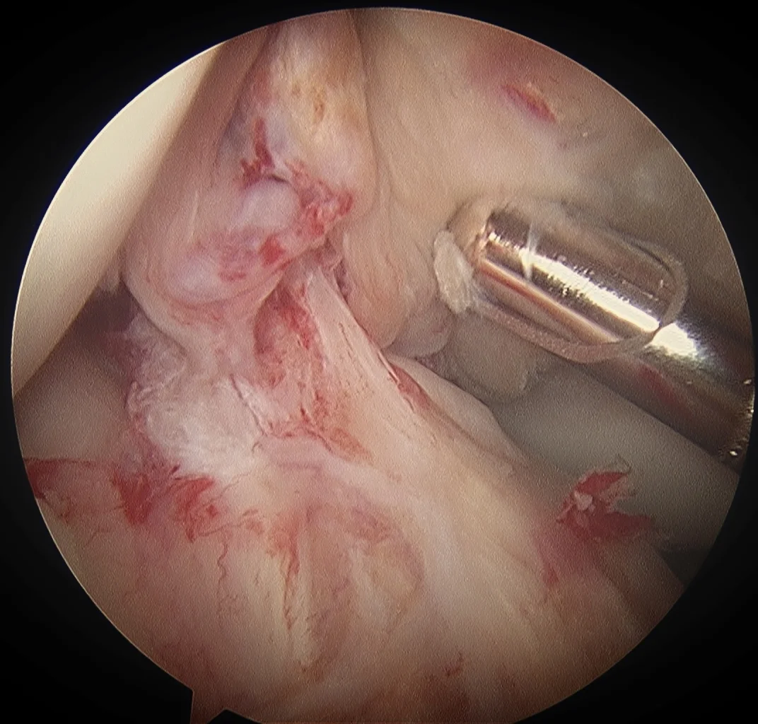 Do I need to have ACL surgery?