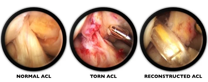 How successful is ACL reconstruction, really?