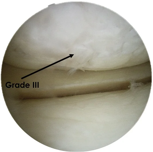 Cartilage Grading Outerbridge Scale — Christopher J. Wahl, MD