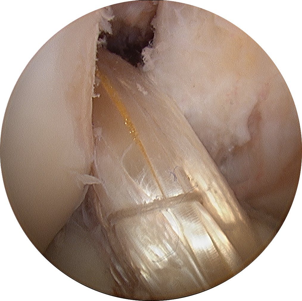 Right ACL Reconstruction with Hamstring Autograft