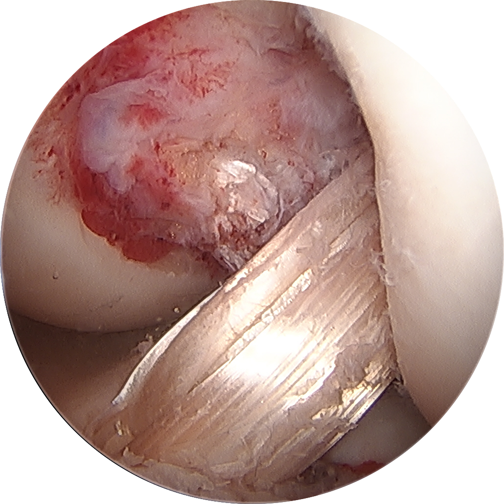 Left ACL Reconstruction with Hamstring Autograft