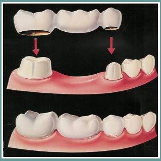A bridge is a more economical option, but doesn't last as long as an implant.