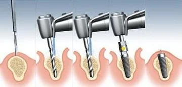 The implant process occurs in phases.
