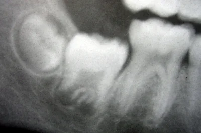 Roots develop after the tooth!